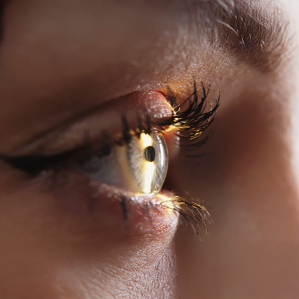 Auge eines Patienten aus Oberursel